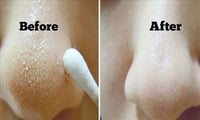 How to remove white heads over nose naturally?